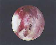 綿製またはプラスチック製乳管を挿入後の炎症